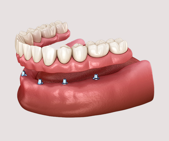 インプラントオーバーデンチャー