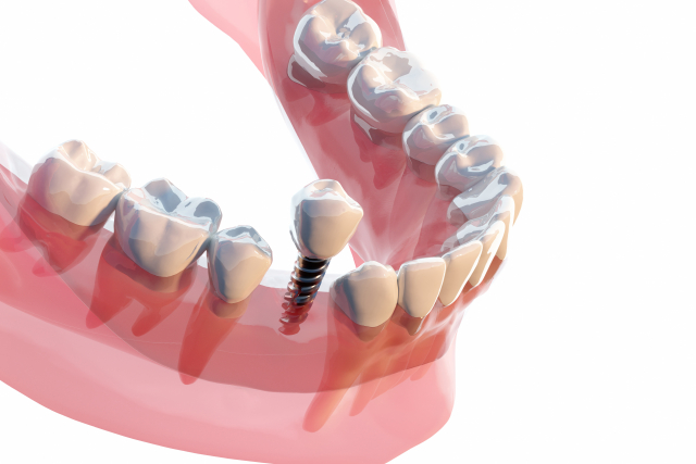 インプラントには保証制度があります。