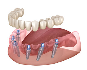 オールオン6とは