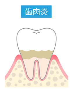 第一段階／歯肉炎