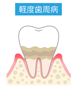 第二段階／軽度歯周炎
