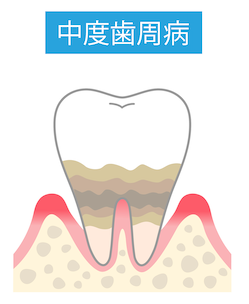 第三段階／中等度歯周炎