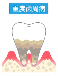 第四段階／重度歯周炎